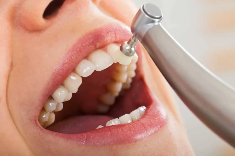 detartraj periaj dentar profesional