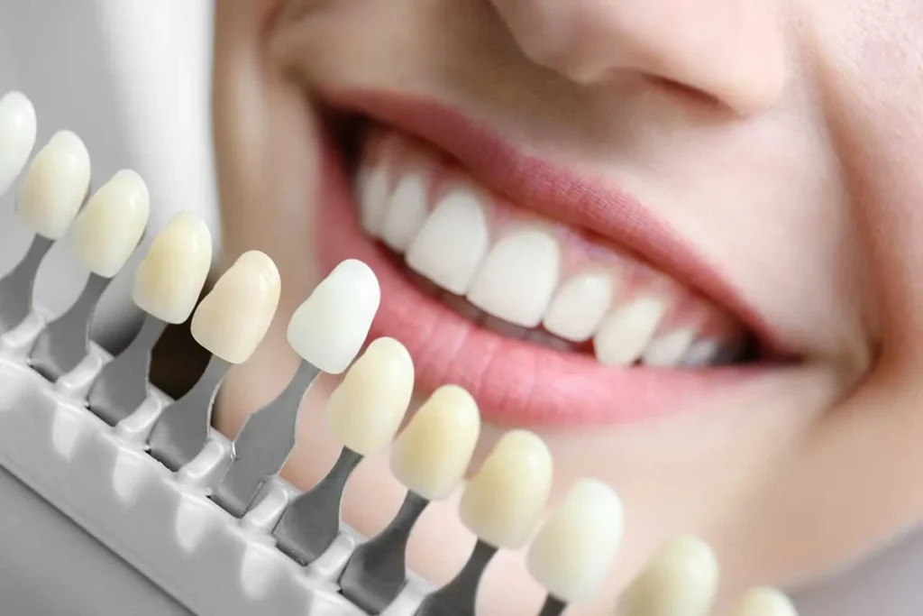 fatete dentare