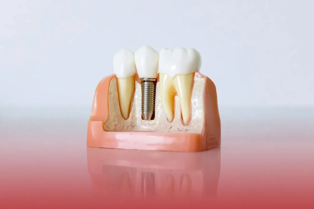 implanturi dentare