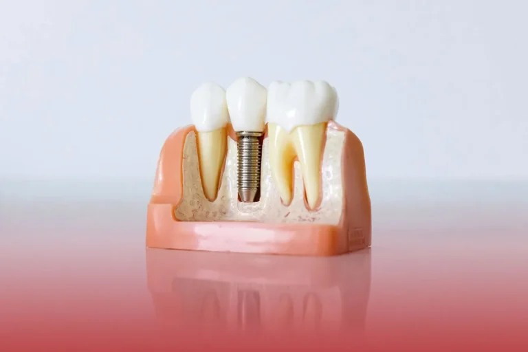 implanturi dentare