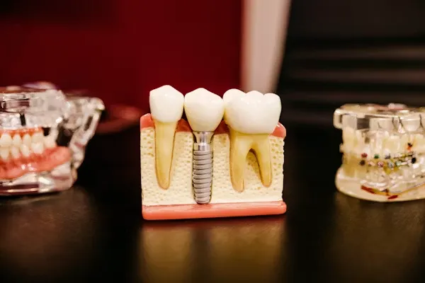 cat costa un implant dentar in Bucuresti