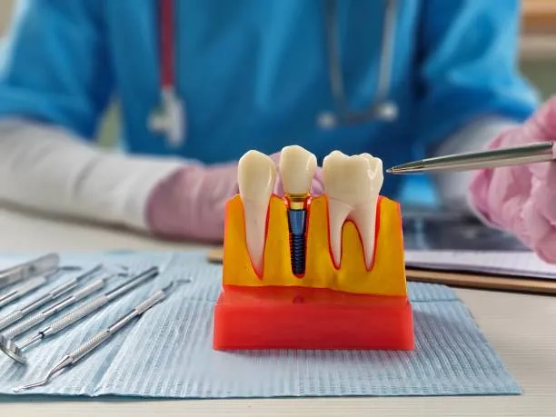 etape implant dentar