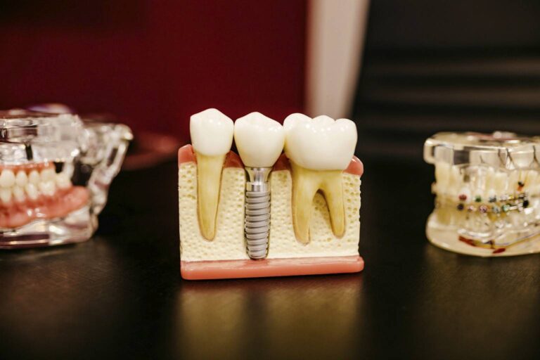 cand ai nevoie de un implant dentar